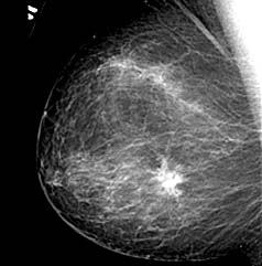 mammogram-bw