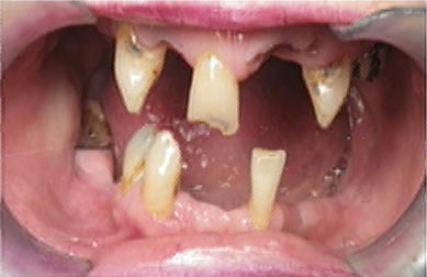 meth_mouth